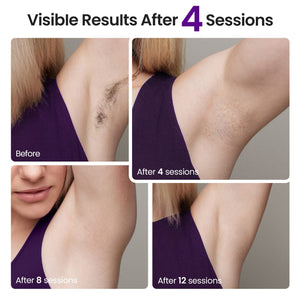 HR-544 NAISIGOO IPL Hair Removal Device Before & After Results