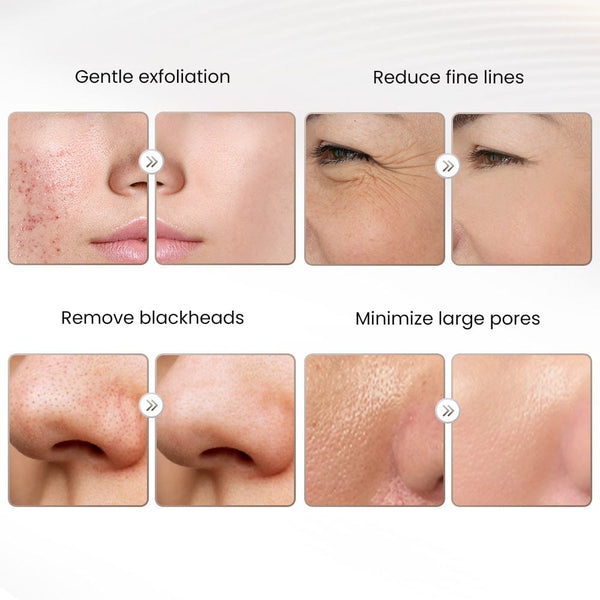 Diamond Microdermabrasion Vacuum Skin Rejuvenation Machine