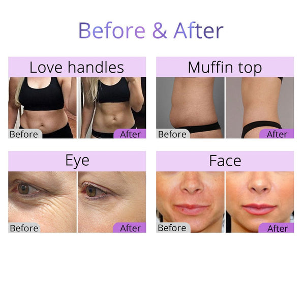 New 80k Cavitation Radio Frequency Machine | Body Contouring
