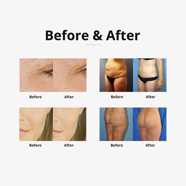 6 In 1 Cavitation RF Vacuum Slimming Machine Skin Tightening