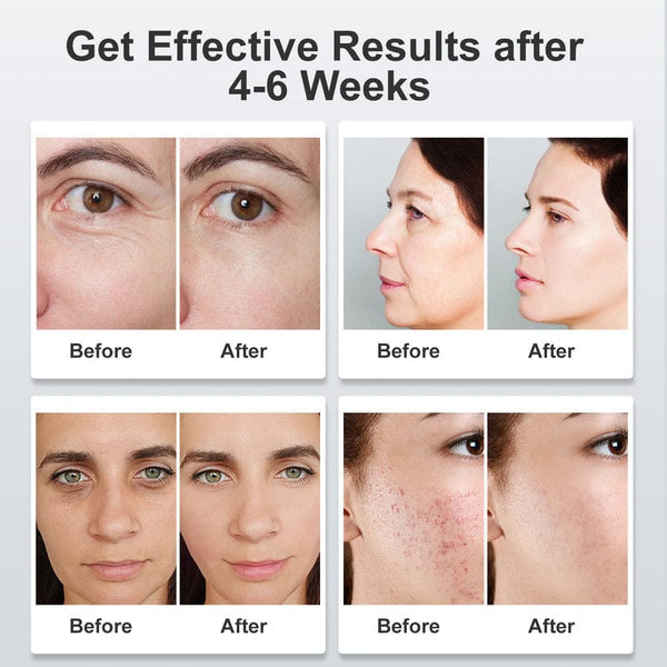 Before & After Results of SK1001WPW 7-Color LED Light Therapy Face Mask