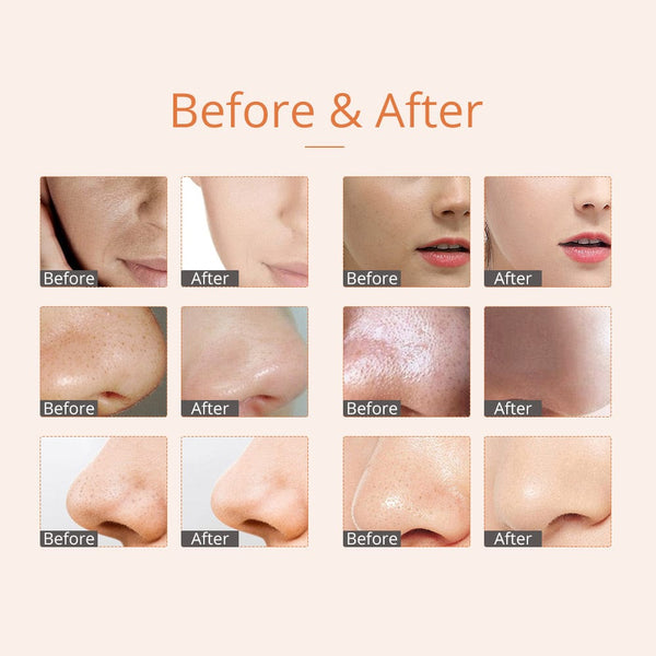 Before & After Results of MS-33P3N 3-In-1 Microdermabrasion Device