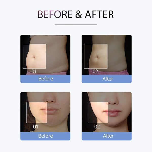 Unoisetion S Shape Cavitation RF Machine -4-in-1 30K