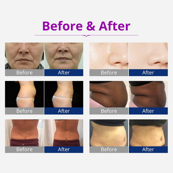 Unoisetion Cavitation Machine - 6-in-1 40K for Fat Removal