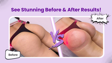 Butt Cupping Before and After: Benefits, Real Results & Reviews