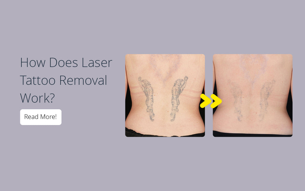 Video: Dr. U Answers Your Questions - Tattoo Removal With Laser | LA