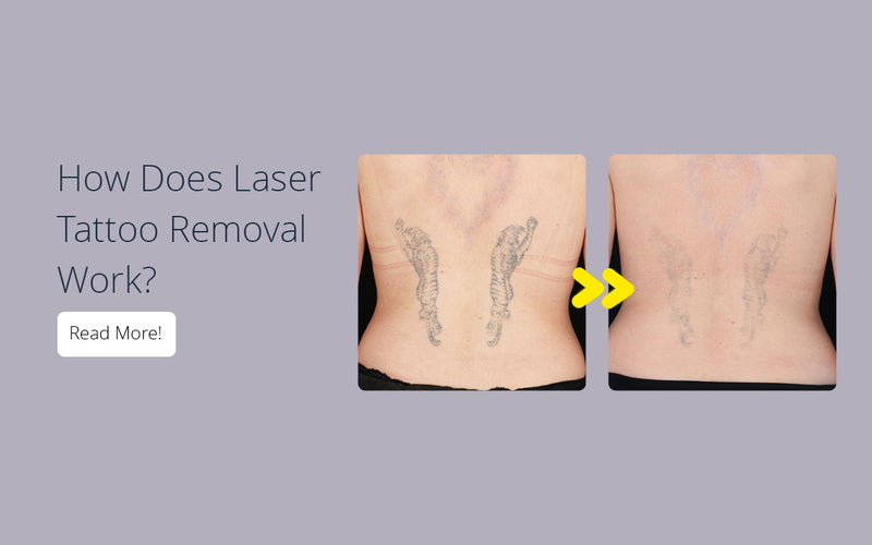 When You No Longer Want the Tattoo You Have — 1192 Laser & Beauty Clinic