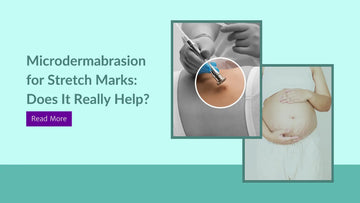 Microdermabrasion for Stretch Marks: Does It Really Help?