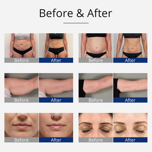 40K Cavitation Machine With 11 Pairs of EMS Pads For Body Contouring