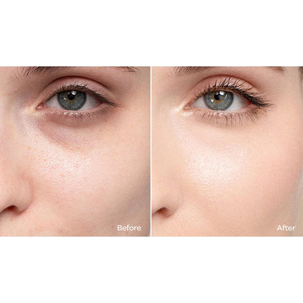 Before and after close-up comparison of under-eye area showing reduced dark circles and improved skin brightness after MYCHWAY hydro dermabrasion facial treatment