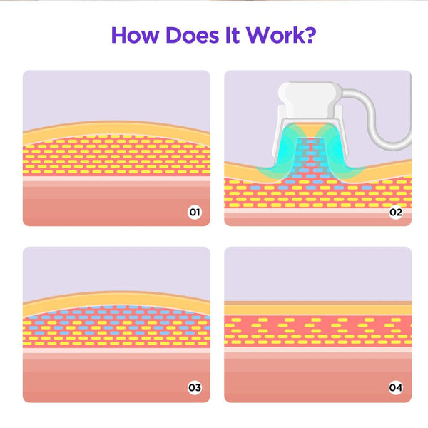 Mychway Freezing Machine With 3 Handles For Body & Chin Contouring