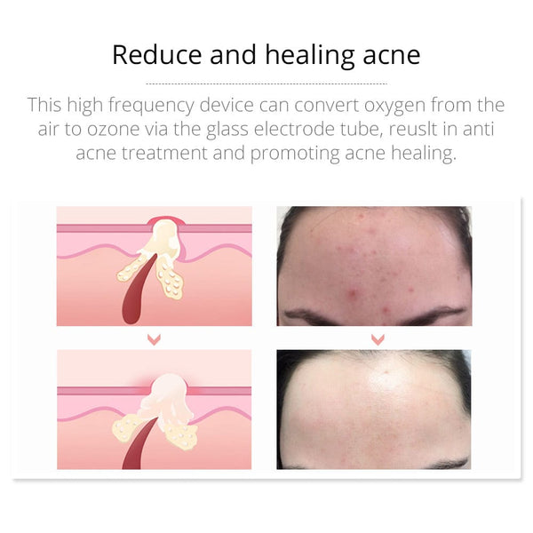 Mychway High Frequency Facial Device For Anti-Inflammation With 4 Electrodes