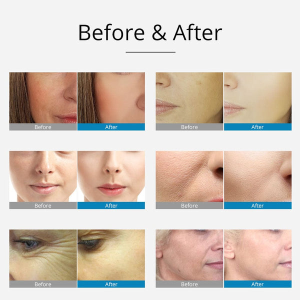 Nano Injector Mesotherapy | EMS RF Anti-Wrinkle Treatment