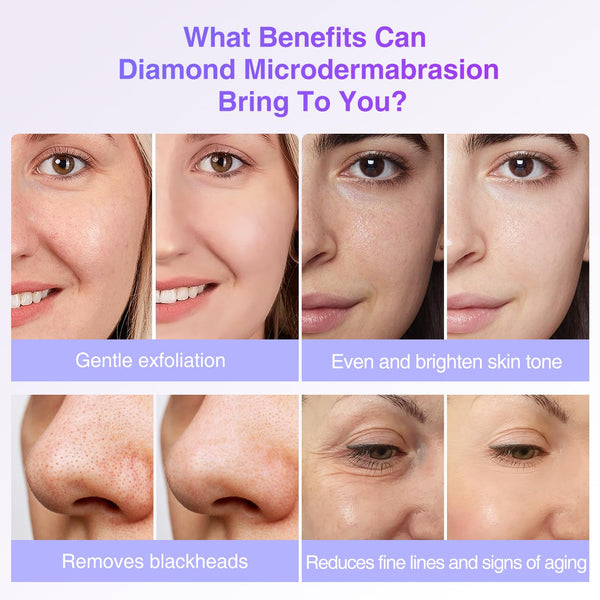 3 Wands & 9 Tips For Diamond Microdermabrasion Devices