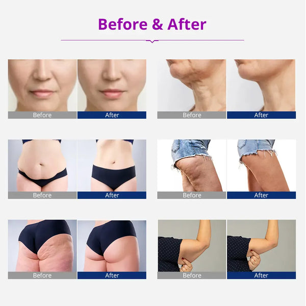 Mychway 5 In 1 Vacuum Cavitation Machine Sextupole 3-polar Multipolar RF Weight Slimming