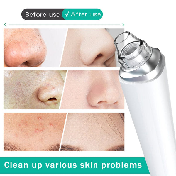 Blackhead Remover Tool With HD Camera For Visual Blackhead Removal