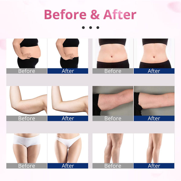 LY-12101J Laser Lipo Machine With 12 Laser Pads Before & After Results