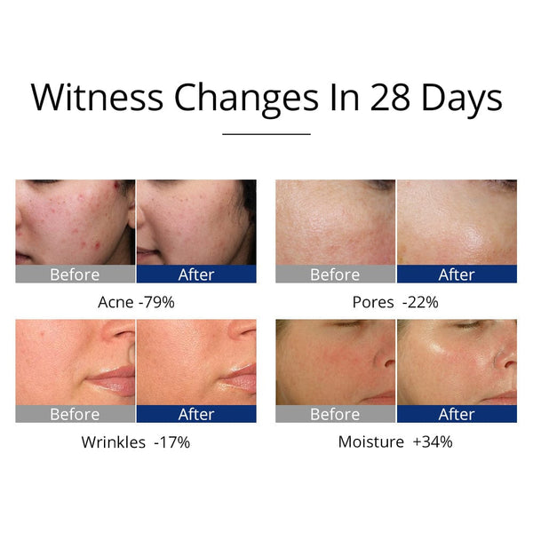 Before & After Results of MS-33J5 3-In-1 High Frequency Facial Beauty Machine