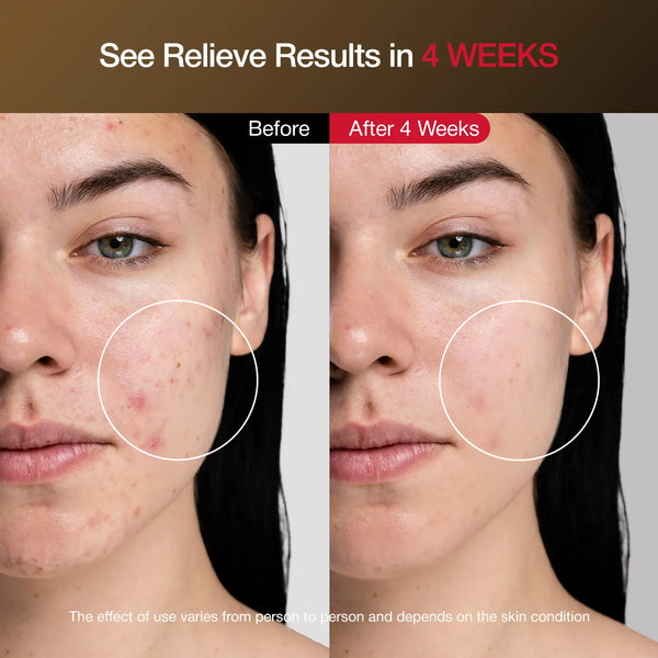 Before and after comparison of a woman's face with acne, showing improvement over 4 weeks.