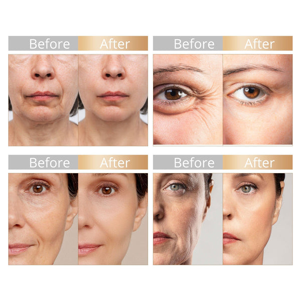 SR-RF56 Radio Frequency Skin Tightening Facial Machine's Before & After Results