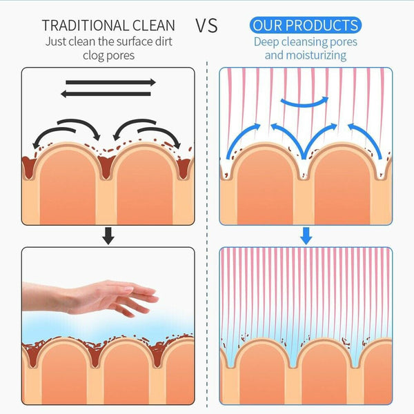 Comparison of Traditional Cleansing and Hydra Dermabrasion Cleansing