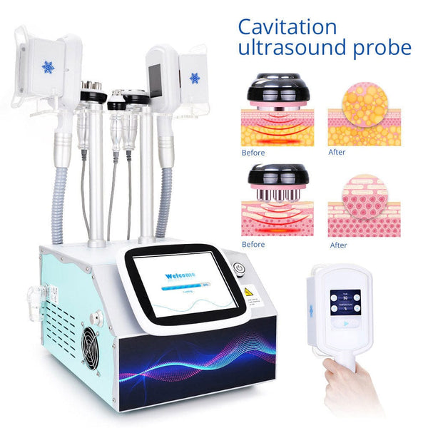 Before & After Results of SM-7202NX Body Freezing Machine With 40K Cavitation