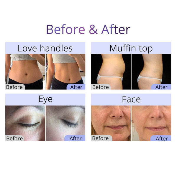 Before & After Results of LS-9XD1SB 10-In-1 40K Cavitation Beauty Machine