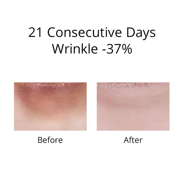 Before & After Wrinkle Removal Results of MS-11R5 Mini RF Device