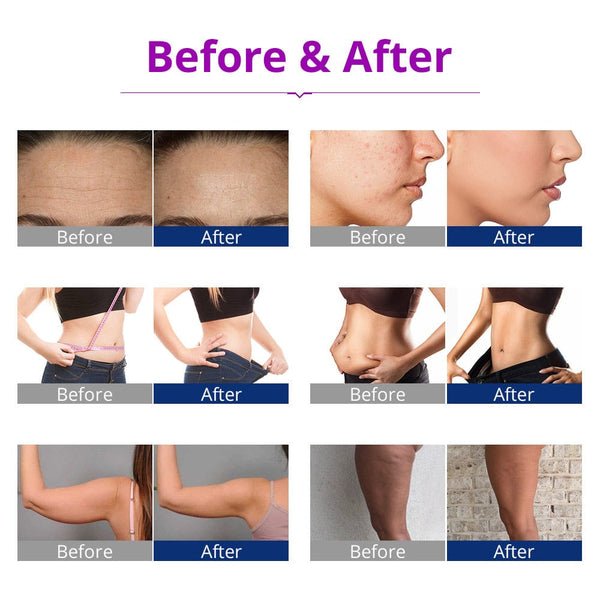 LY-54K2S 6-In-1 Cavitation Body Contouring Machine Before & After Results