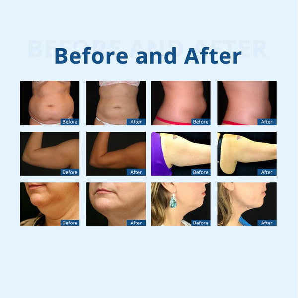 Before & After Results of WL-7009CBX CoolSculpting Machine 